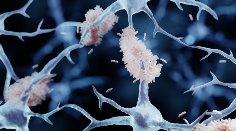 Amyloid plaques are misfolded protein aggregates between neurons, Alzheimer's disease illustration