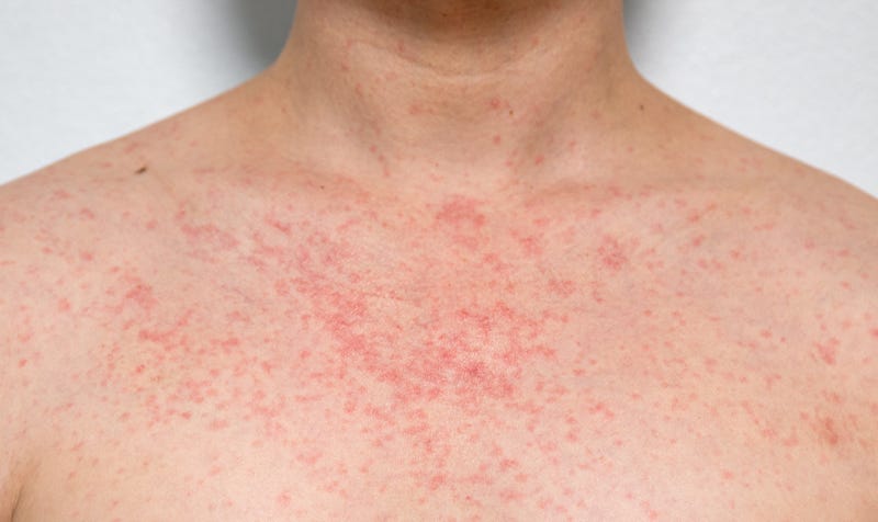 measles