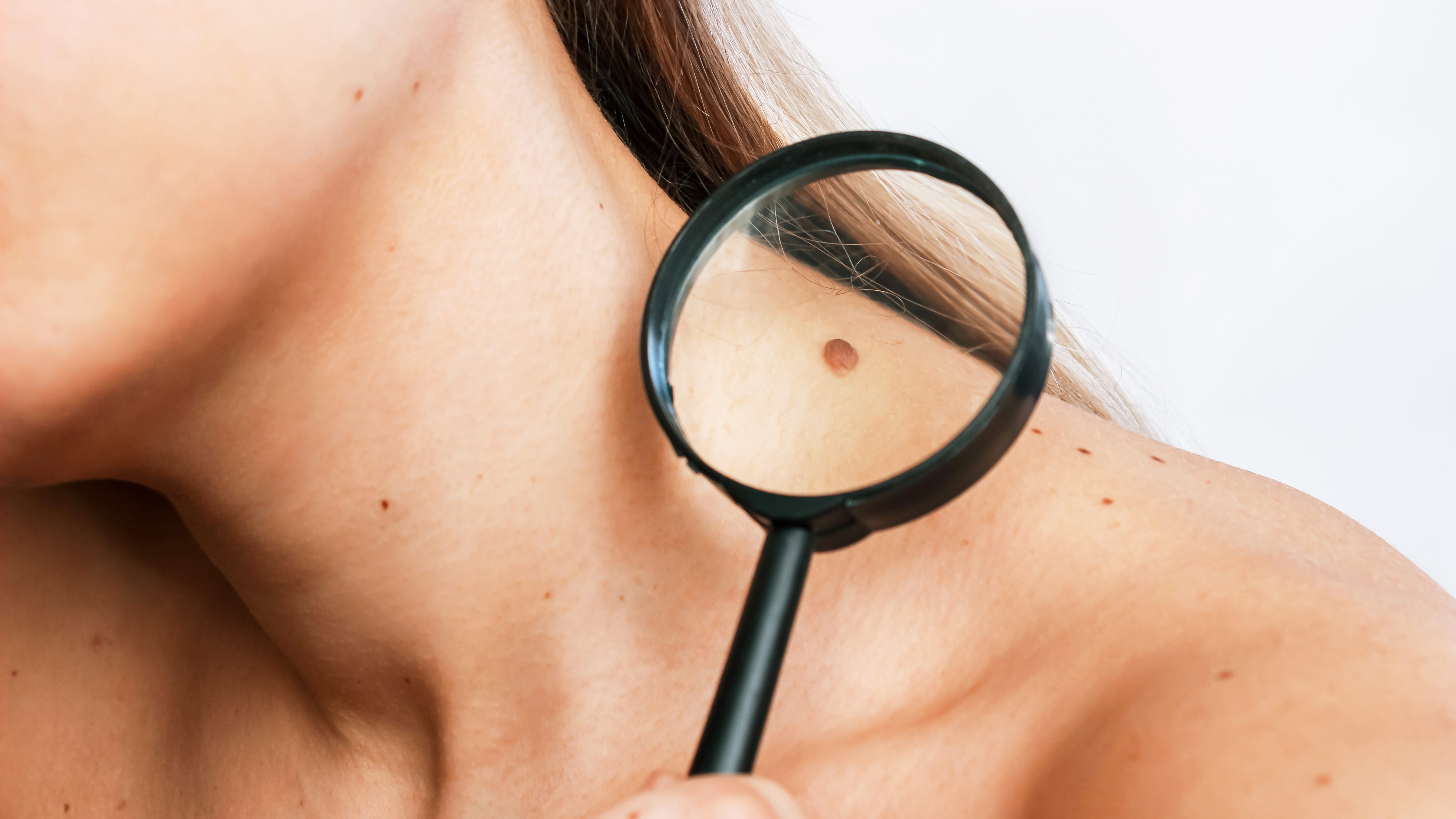 Melanoma is the deadliest form of skin cancer — Could an experimental vaccine help change that?