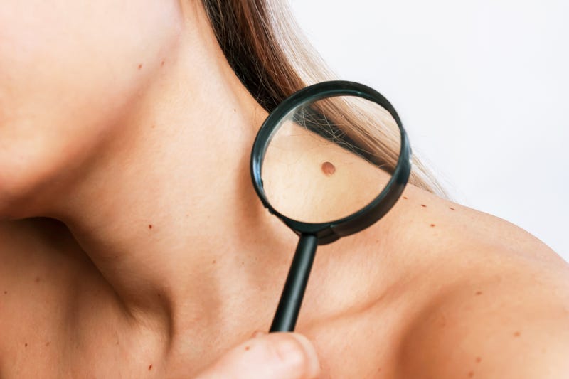 Woman with skin spot on shoulder