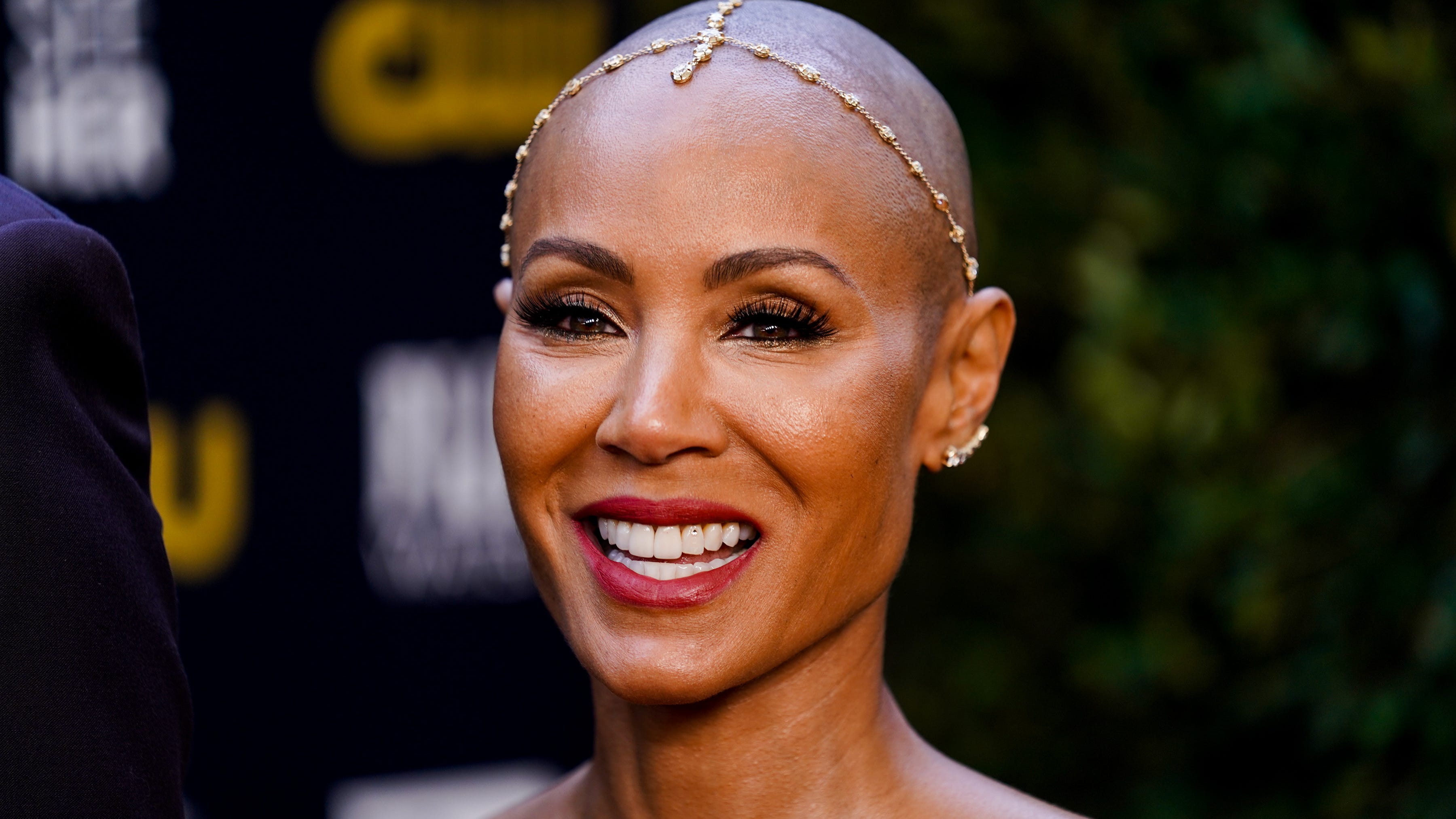The hair loss condition at the center of the infamous Oscars slap