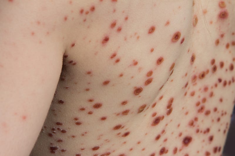 chickenpox