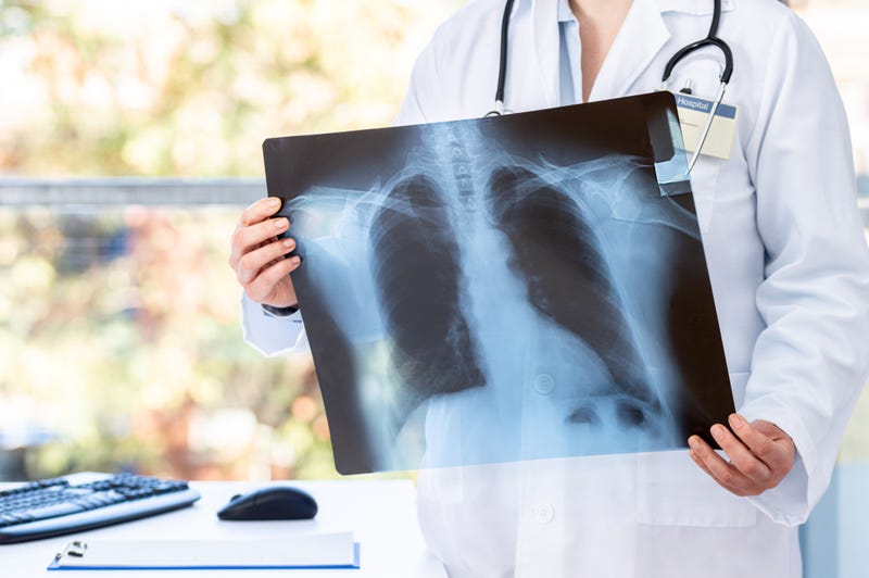 Doctor looking at an X-Ray of a patient with long COVID