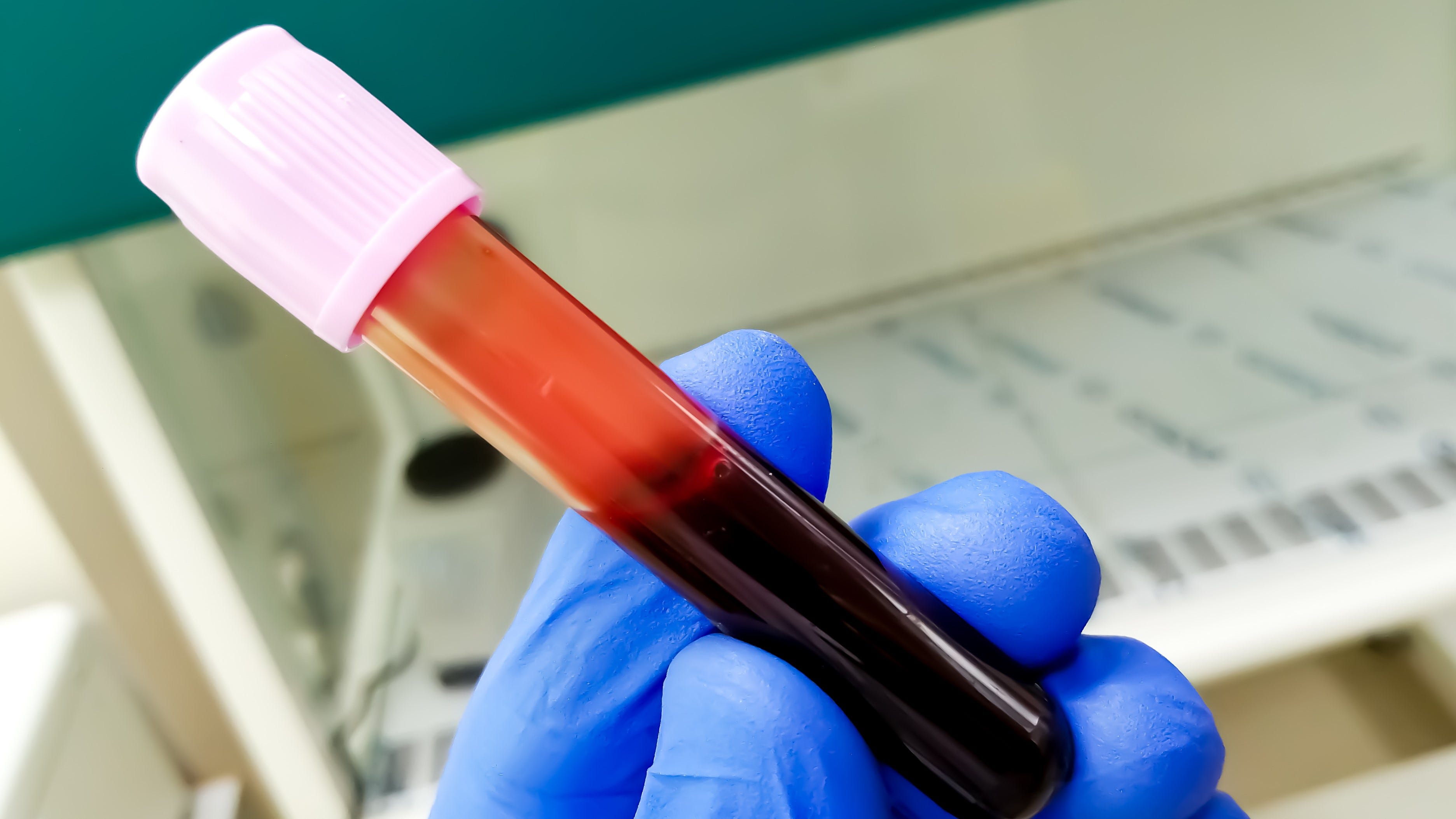 New blood test helps doctors cut down on hospital emergency room CT scans