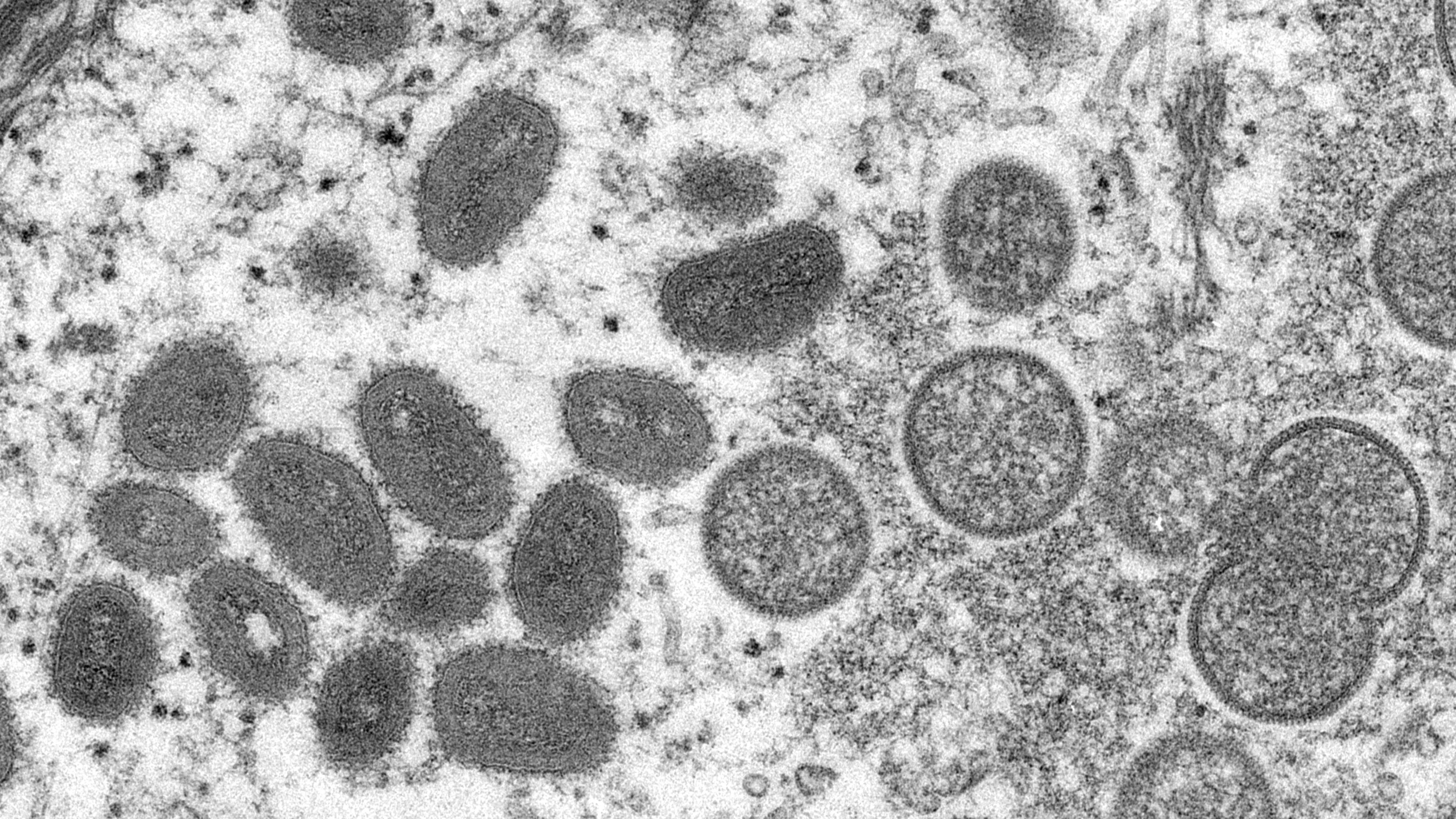 Monkeypox outbreak primarily spreading through sex with men, CDC and WHO warn