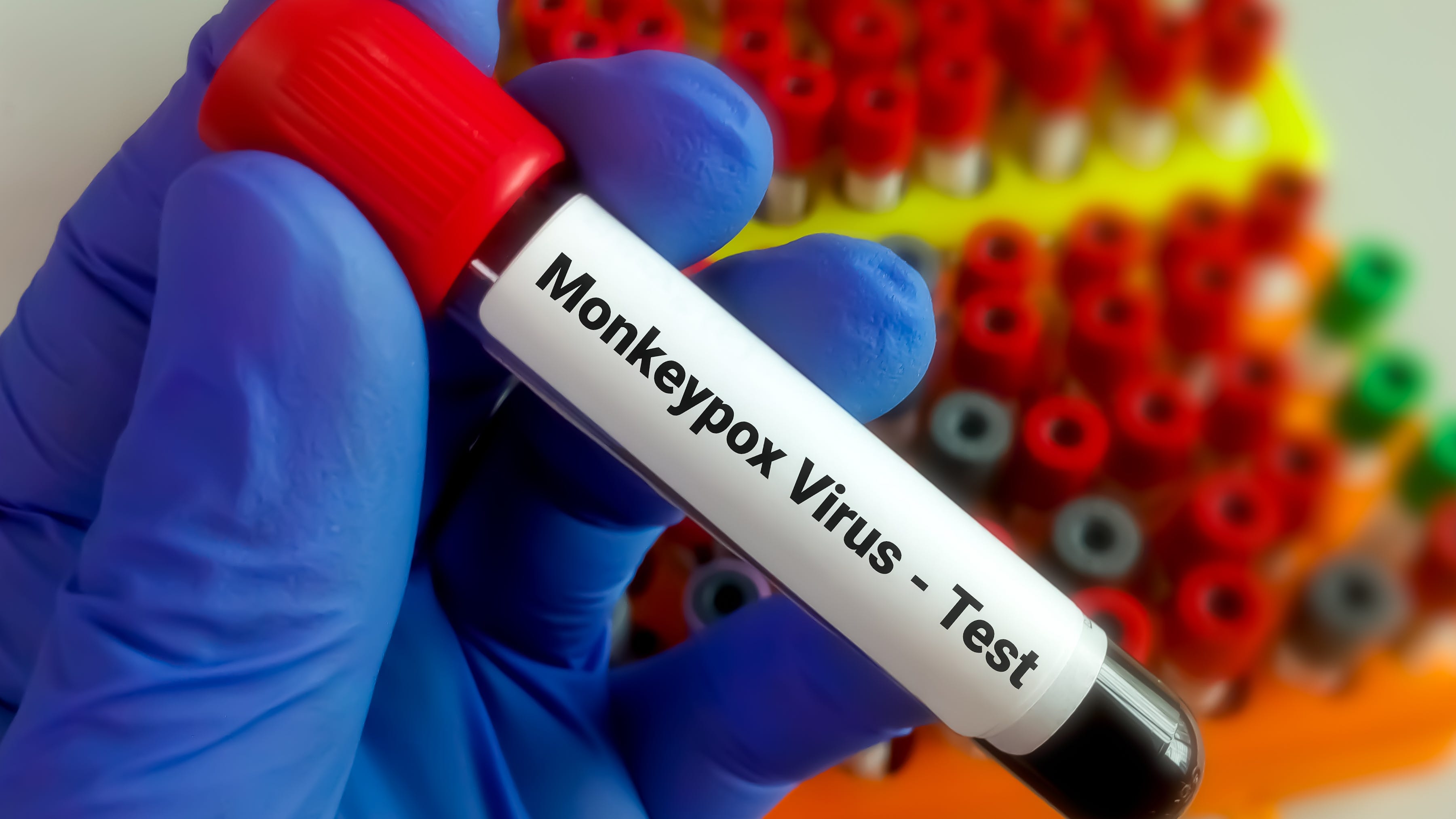 Indiana Department of Health identifies state's first probable case of monkeypox