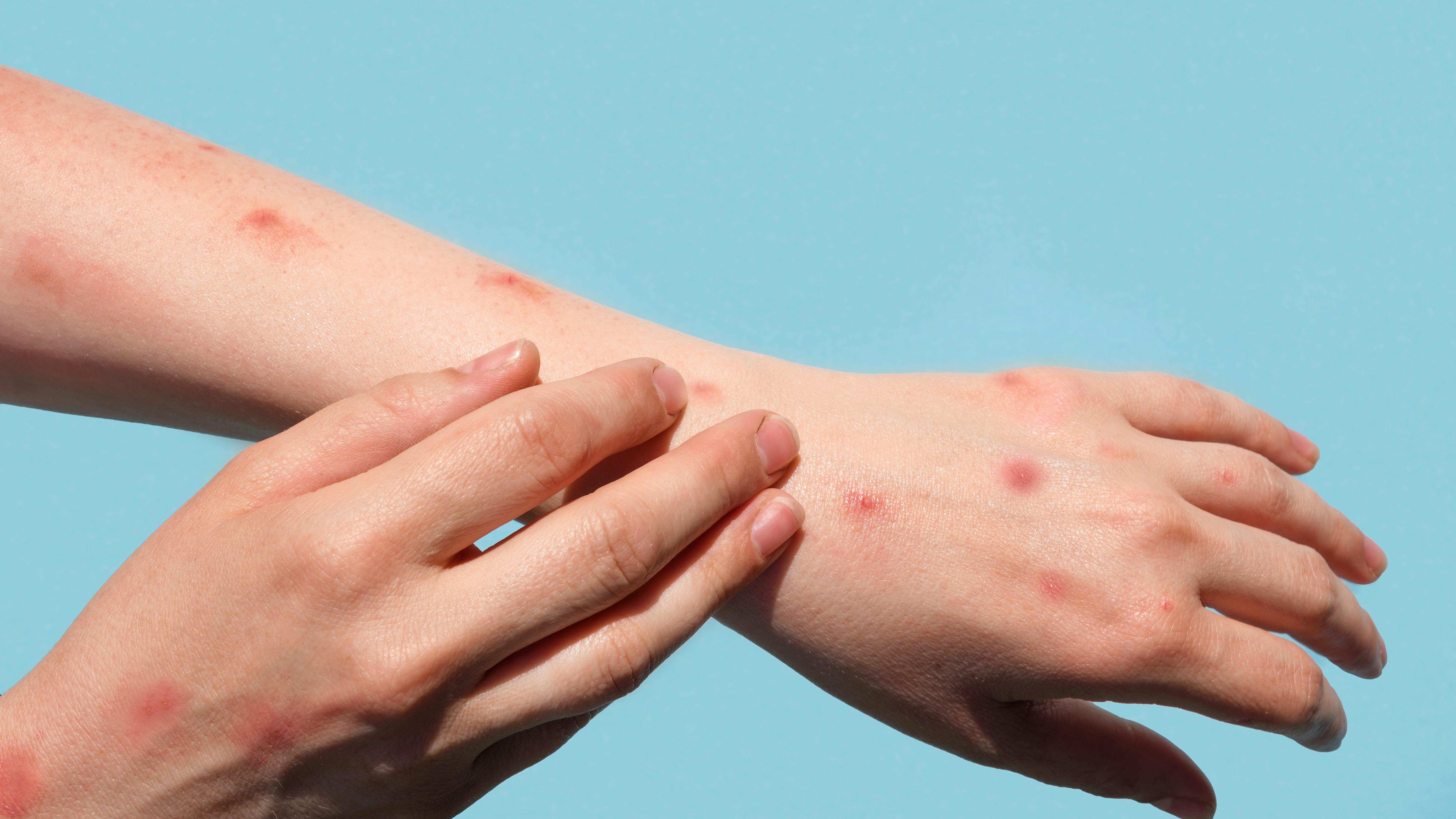 L.A. County Health Dept., CDC confirm first death in County due to monkeypox
