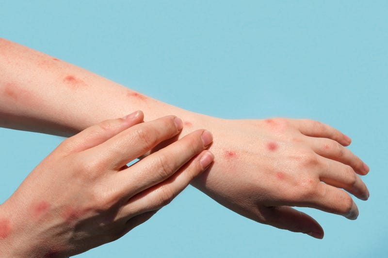 Patient with monkeypox shows painful rash, red spots blisters on the hand.