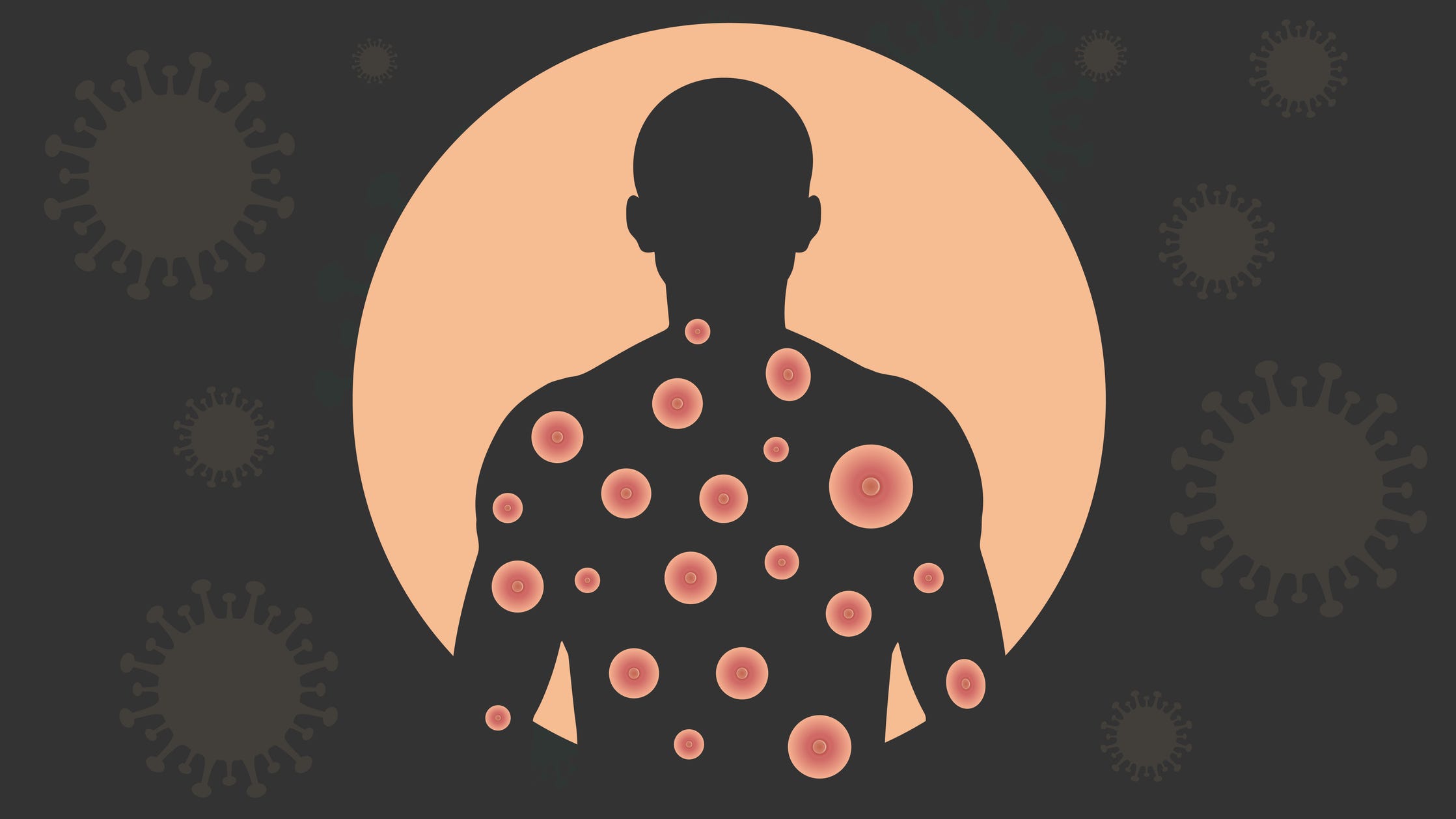 U.S. officials say monkeypox can still be stopped