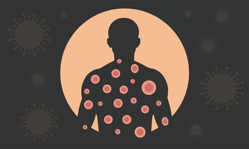 Illustration of monkeypox.