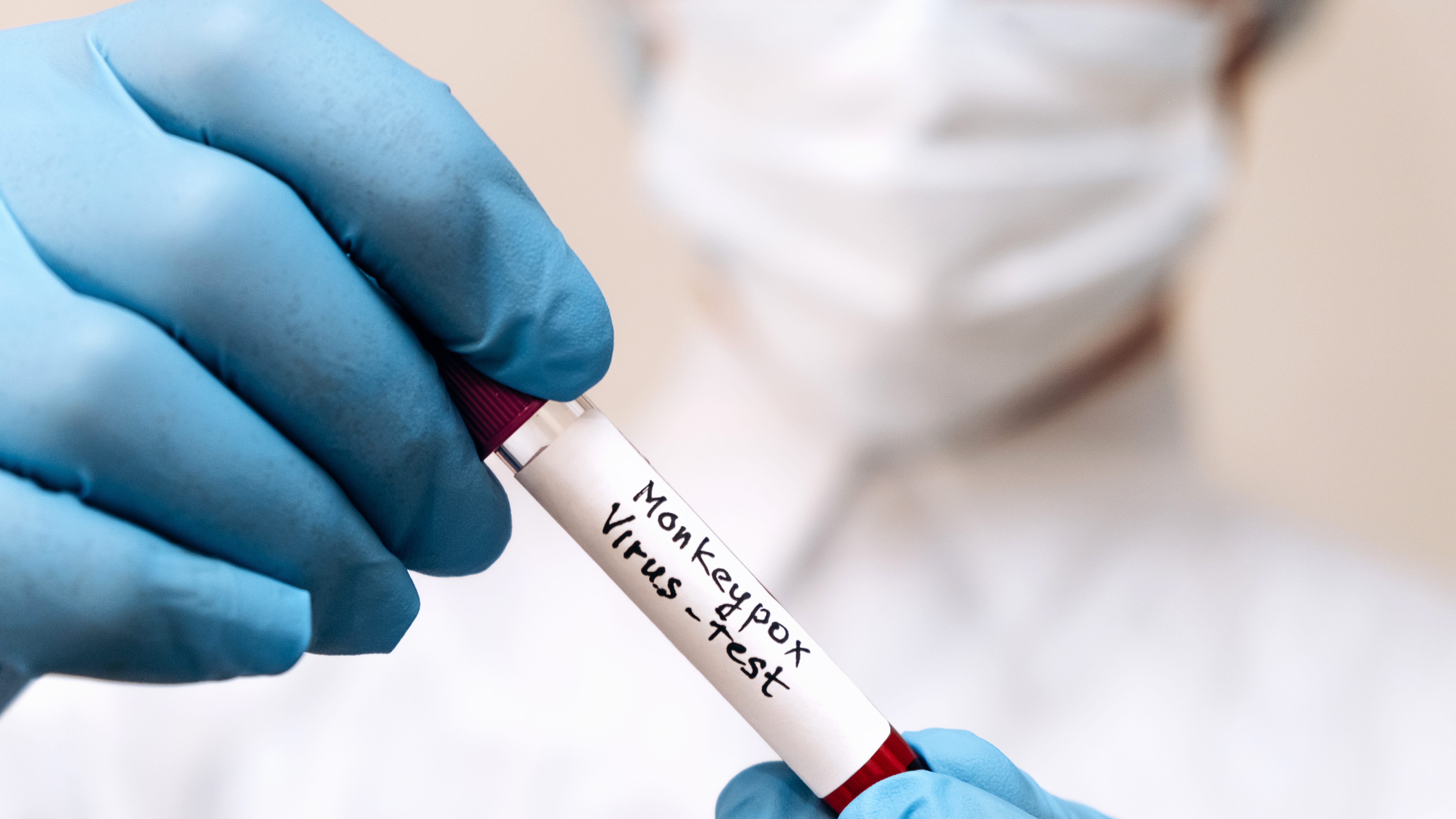 What you need to know about monkeypox