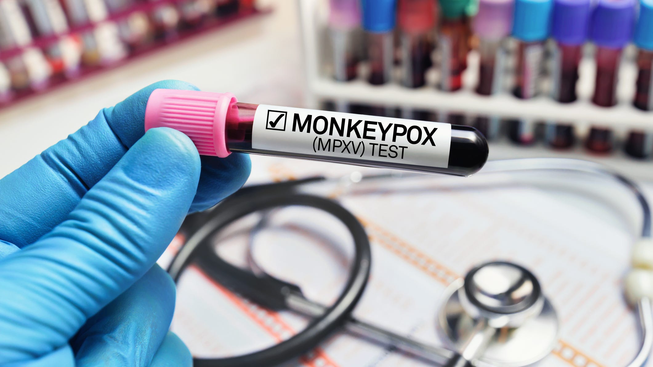 Denton County prepares for more Monkeypox cases