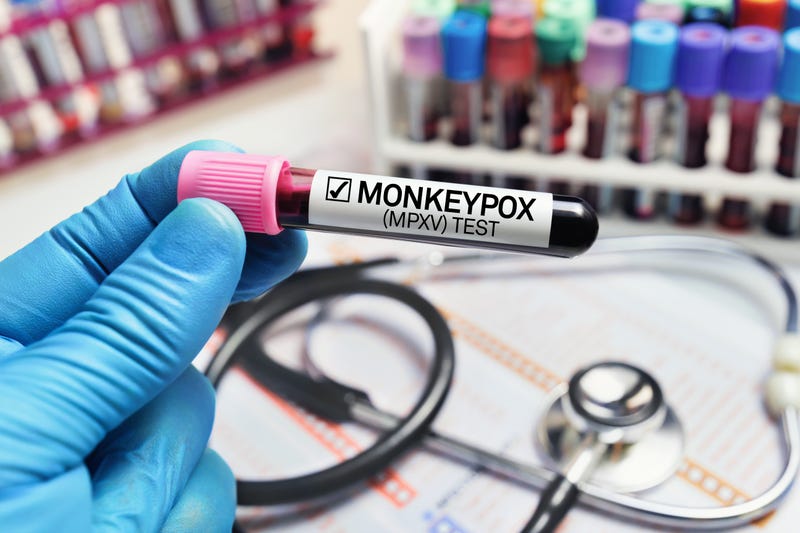 San Francisco health officials announced the first probable case of monkeypox has been identified in a resident through testing at a California Department of Public Health laboratory.