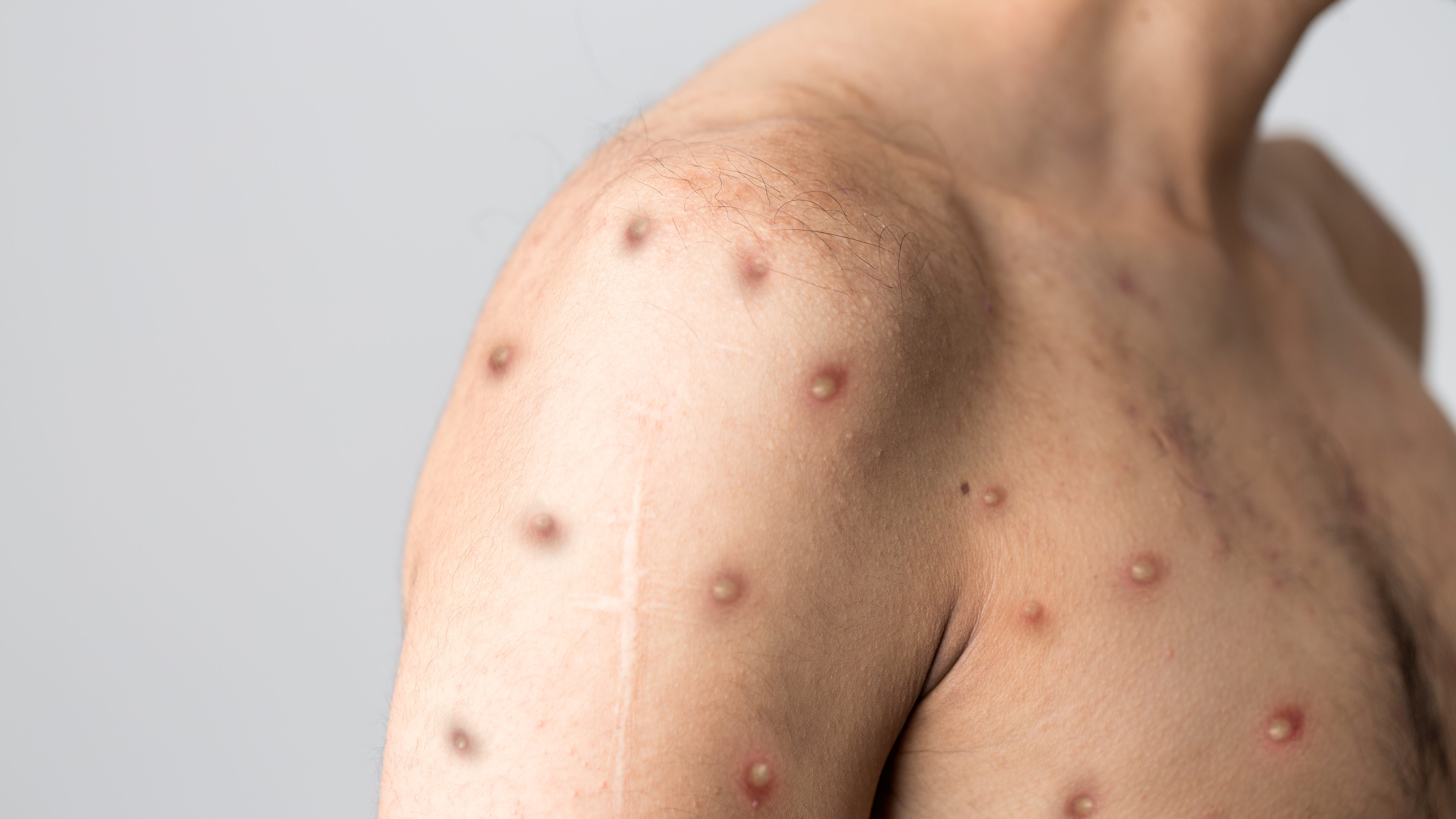 Dallas County monkeypox patient potentially spread virus to others at festival