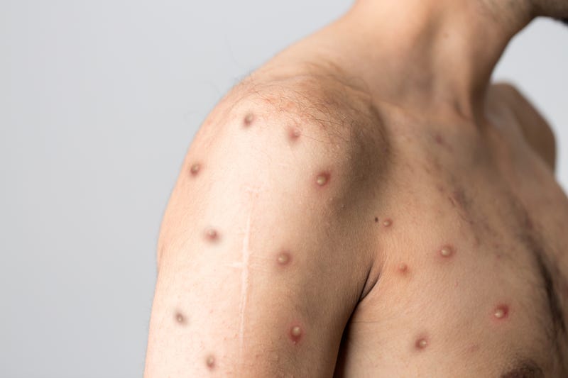 monkey pox