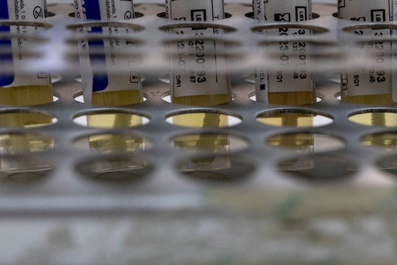 Suspected monkeypox samples stands on a table before being PCR tested at the microbiology laboratory of La Paz Hospital on June 06, 2022 in Madrid, Spain. 