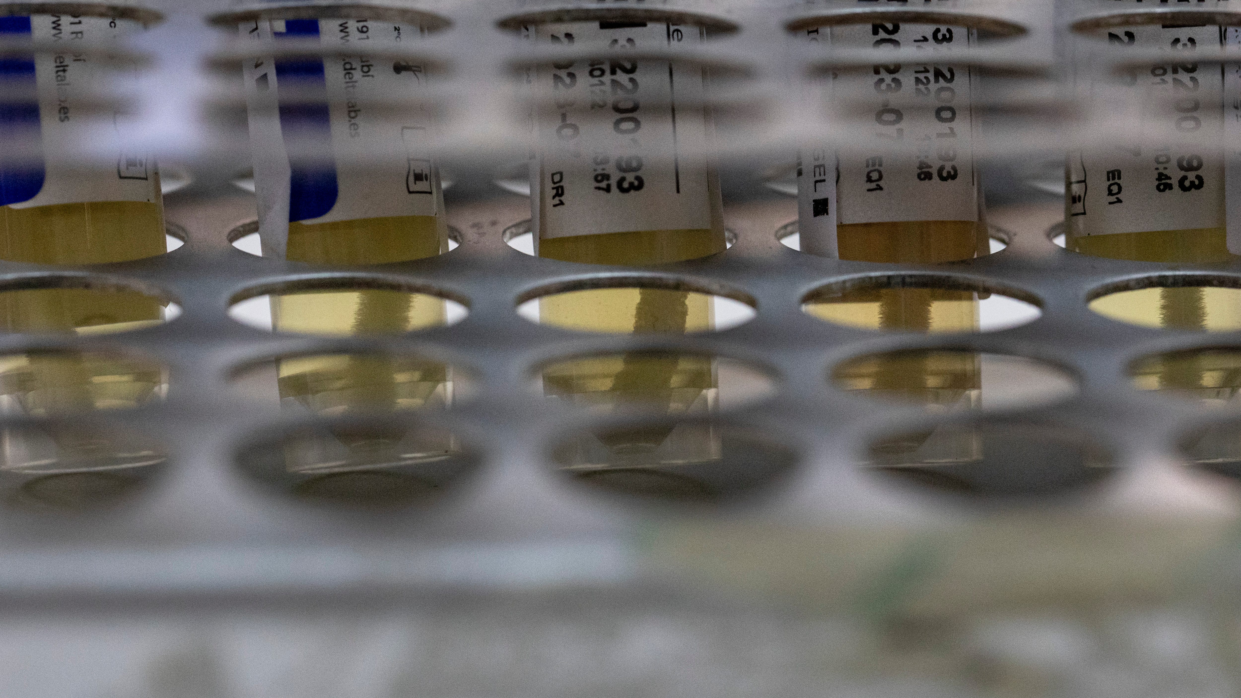 Minnesota's first presumptive case of monkeypox is detected