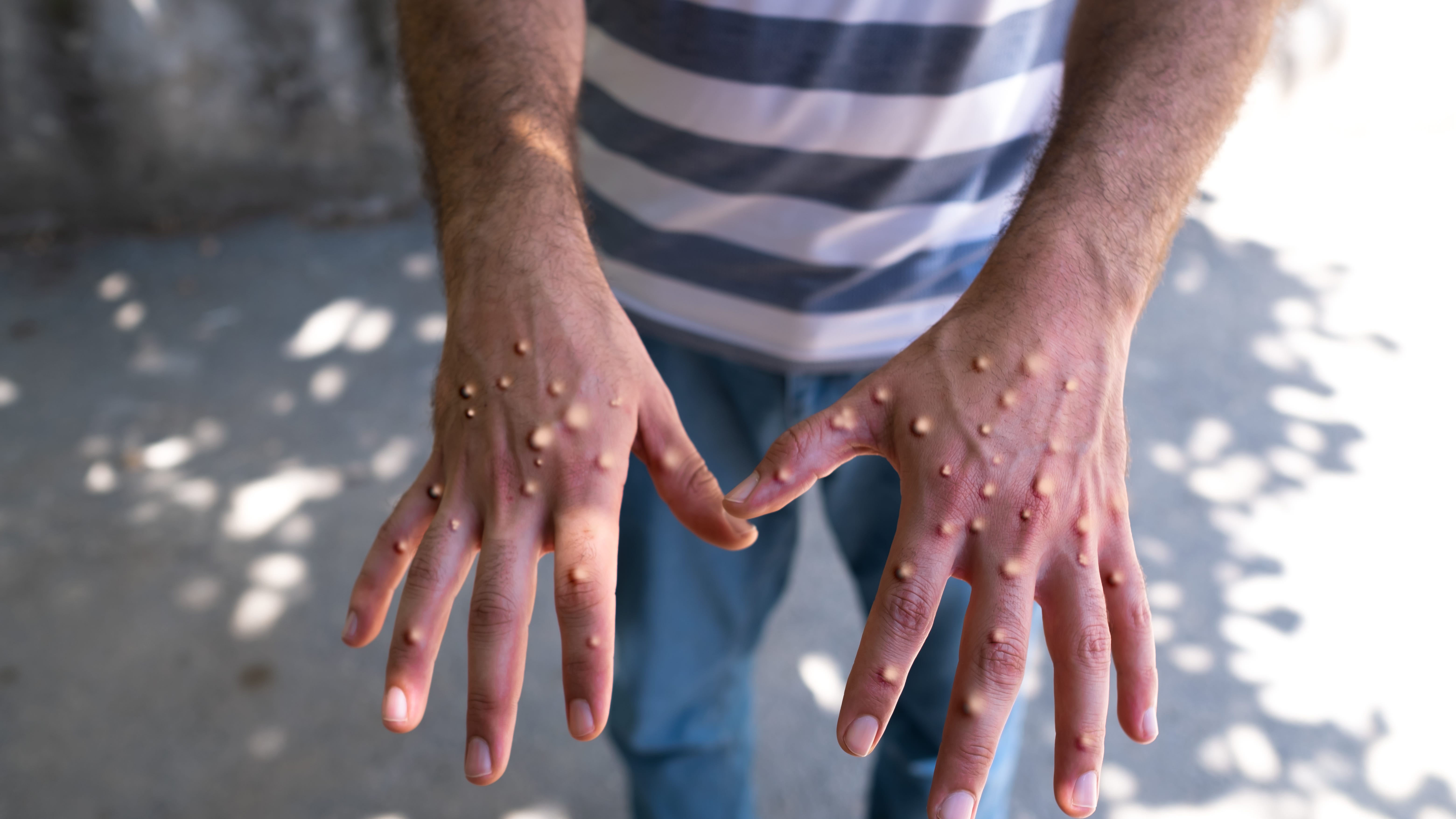 Long Beach announces first case of child with monkeypox