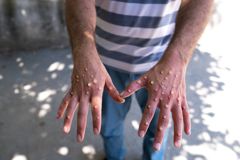 Monkeypox
