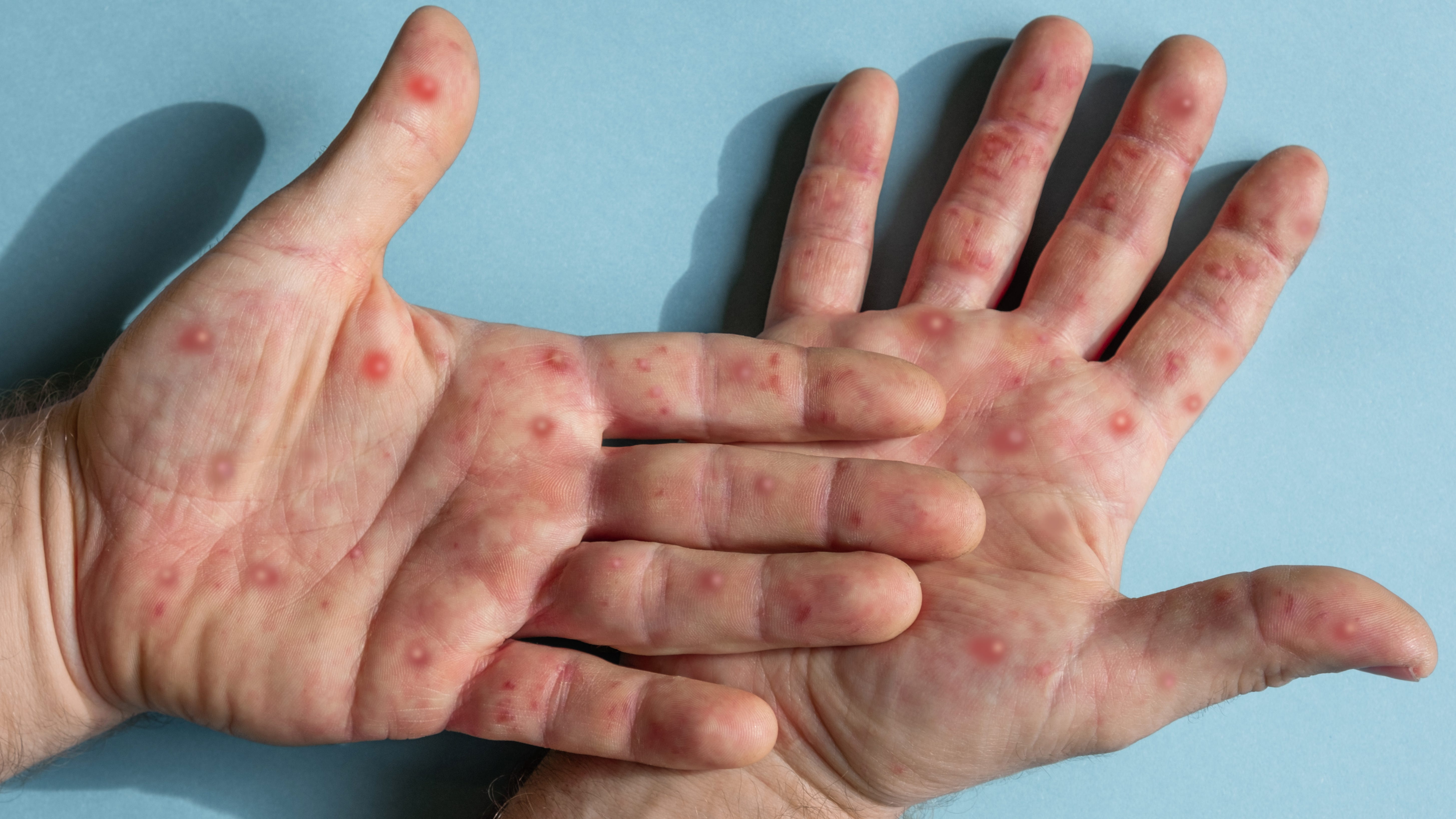 Dallas County declares monkeypox public health emergency