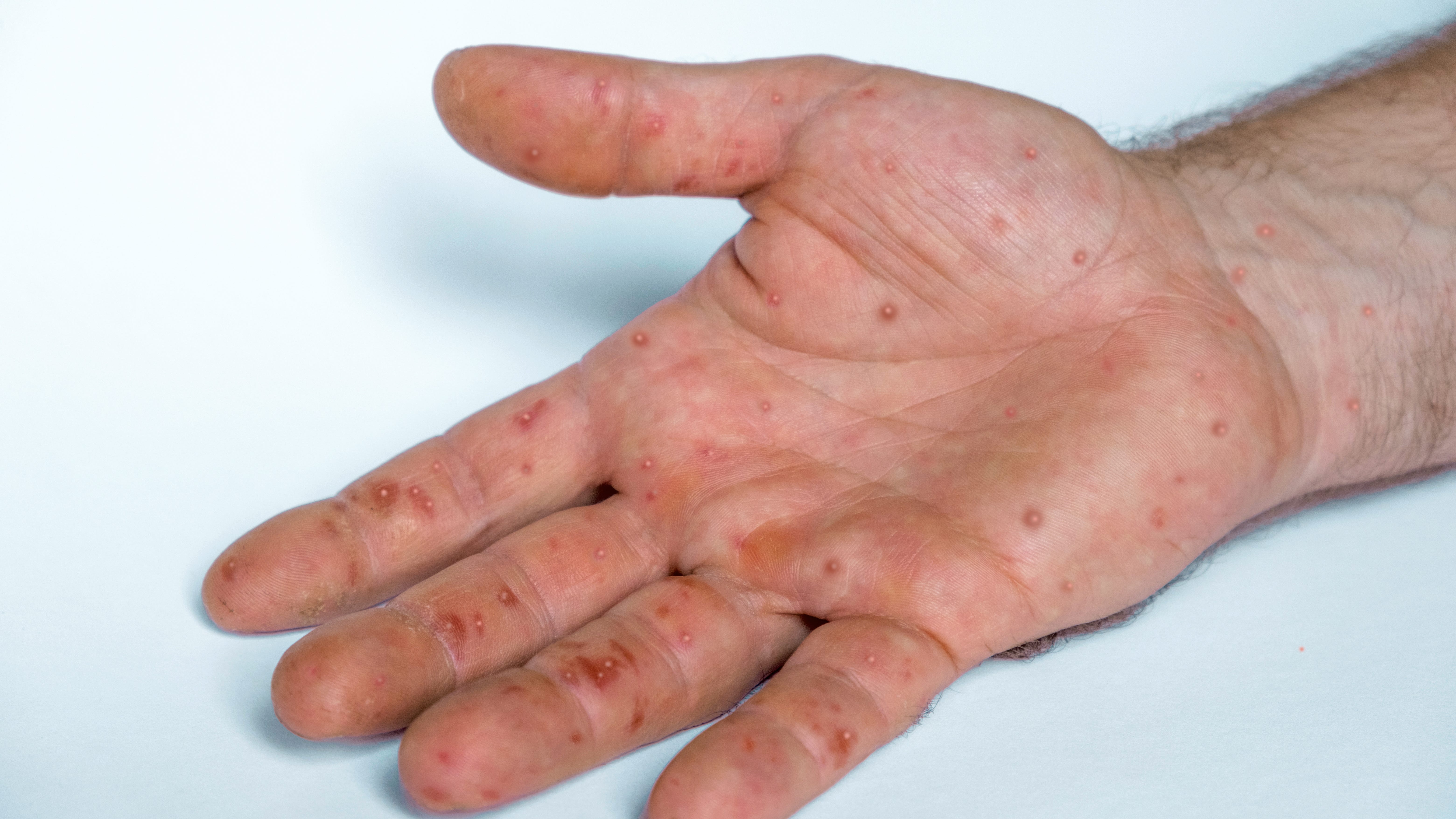Ask The Expert: What is Dallas County doing about the monkeypox spread?