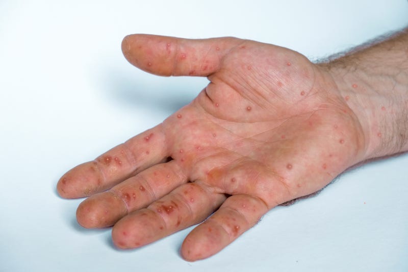 Monkeypox