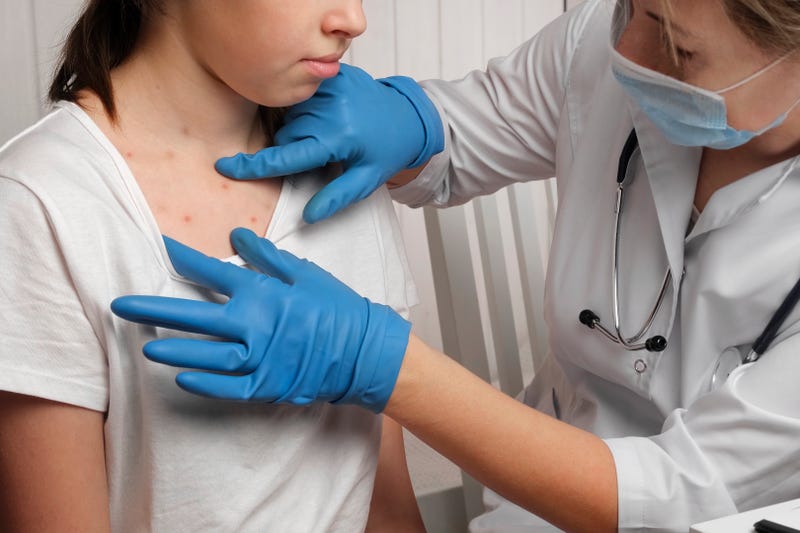 The Minnesota Department of Health is sharing details about three more cases of measles reported this week. That brings the total number of cases in the state rises to 15.