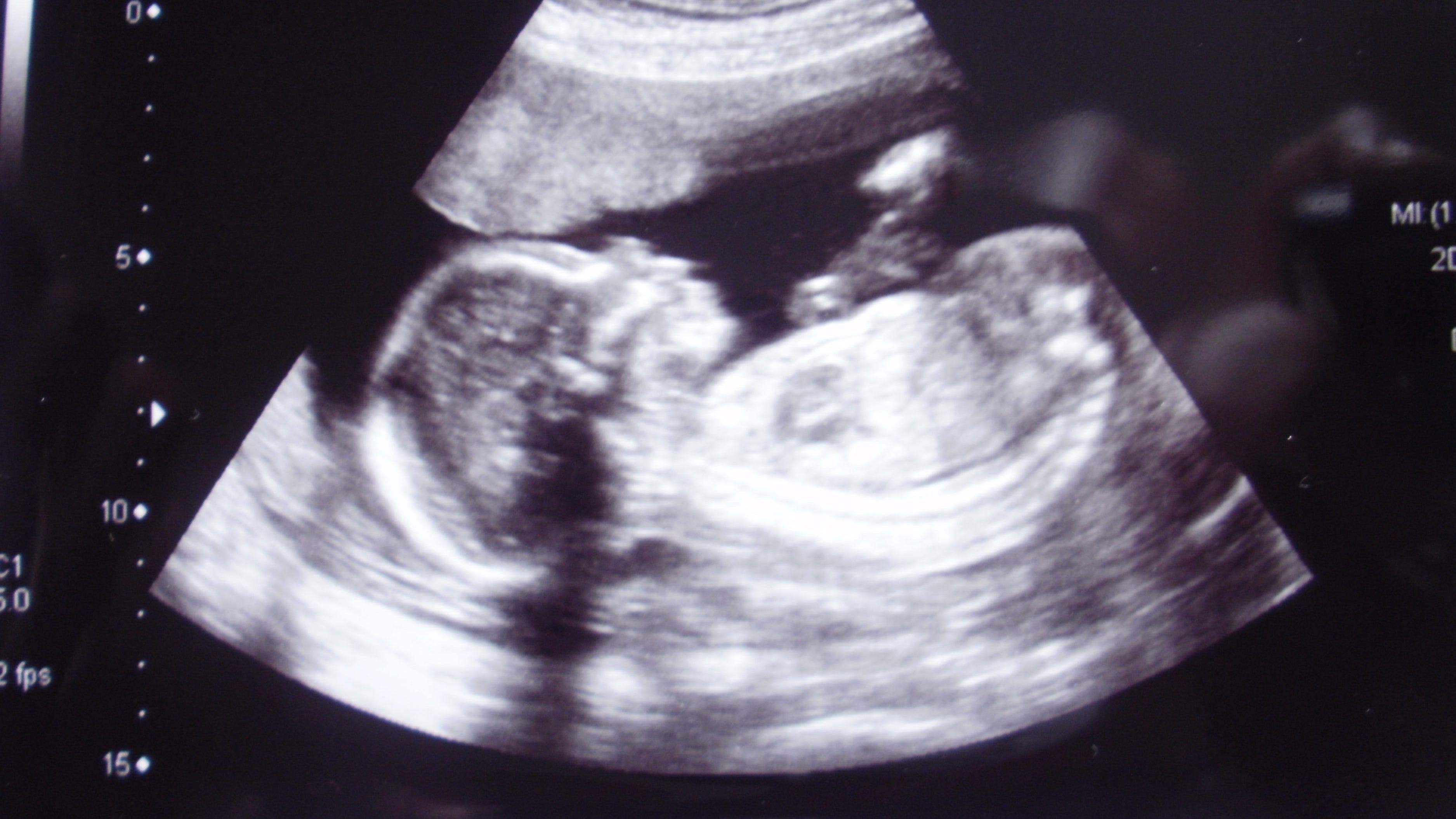 Doctors do first-ever brain surgery on unborn baby