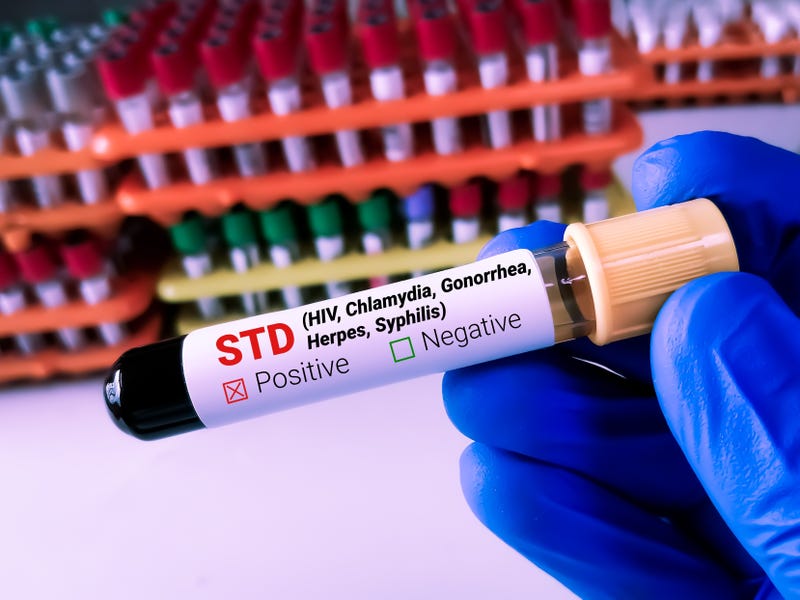 STD test to look for abnormalities from blood, blood sample to analyze in the laboratory, blood in test tube
