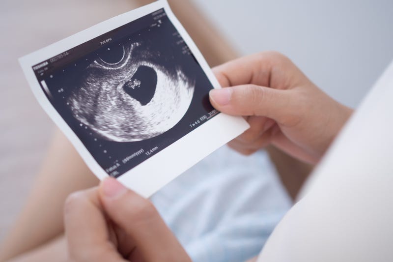 Ultrasound photo of a baby. 