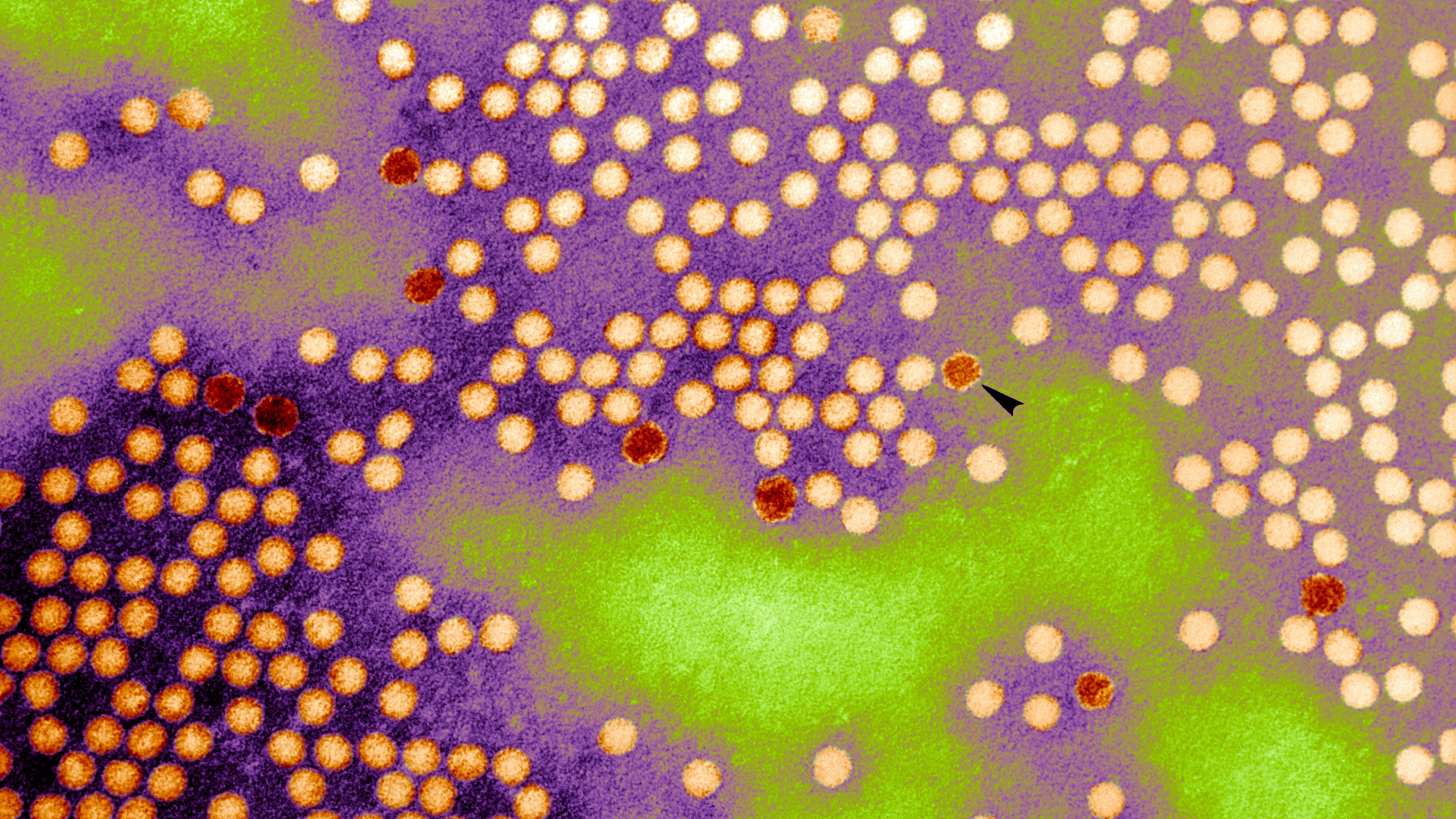 Polio case found in Rockland County; 1st US case since 2013