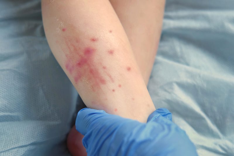 measles