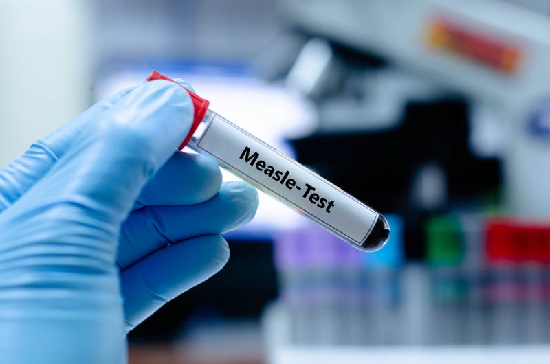 Measles