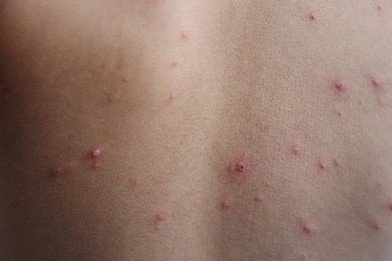 measles