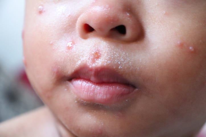 A child with measles