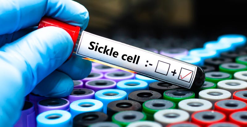 sickle cell 