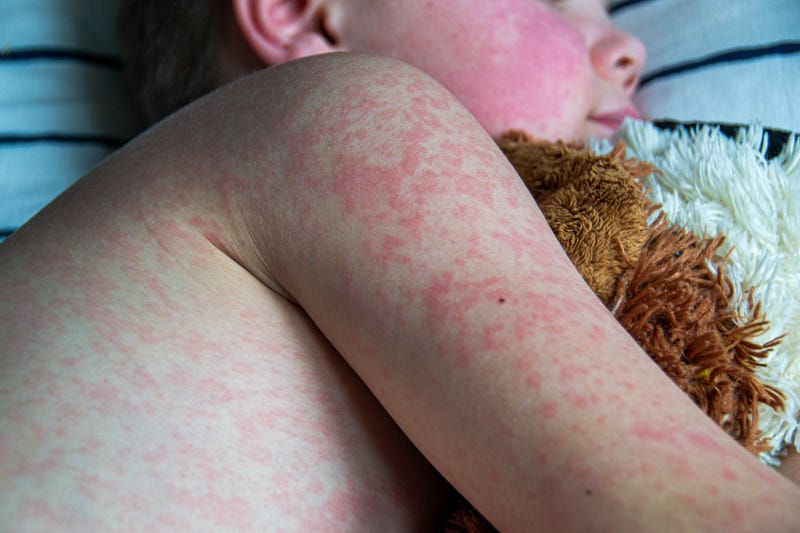 Measles