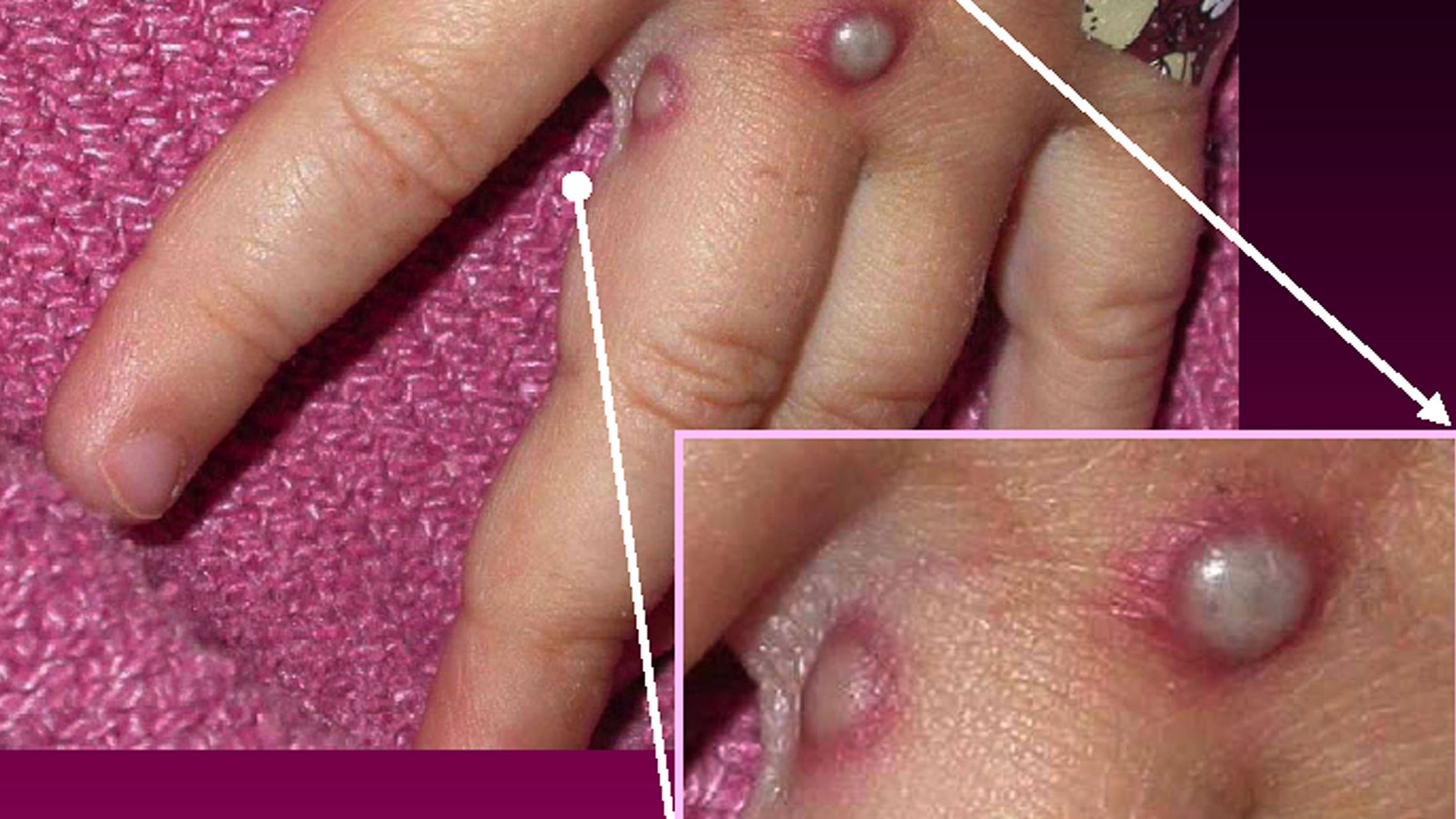 Spain confirms 7 monkeypox cases as European outbreak grows