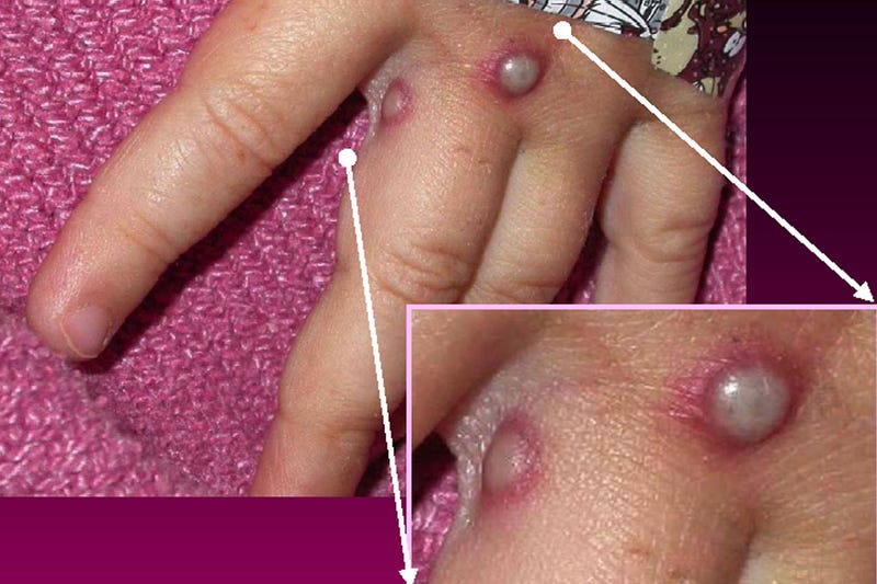 Monkey Pox Lesions.