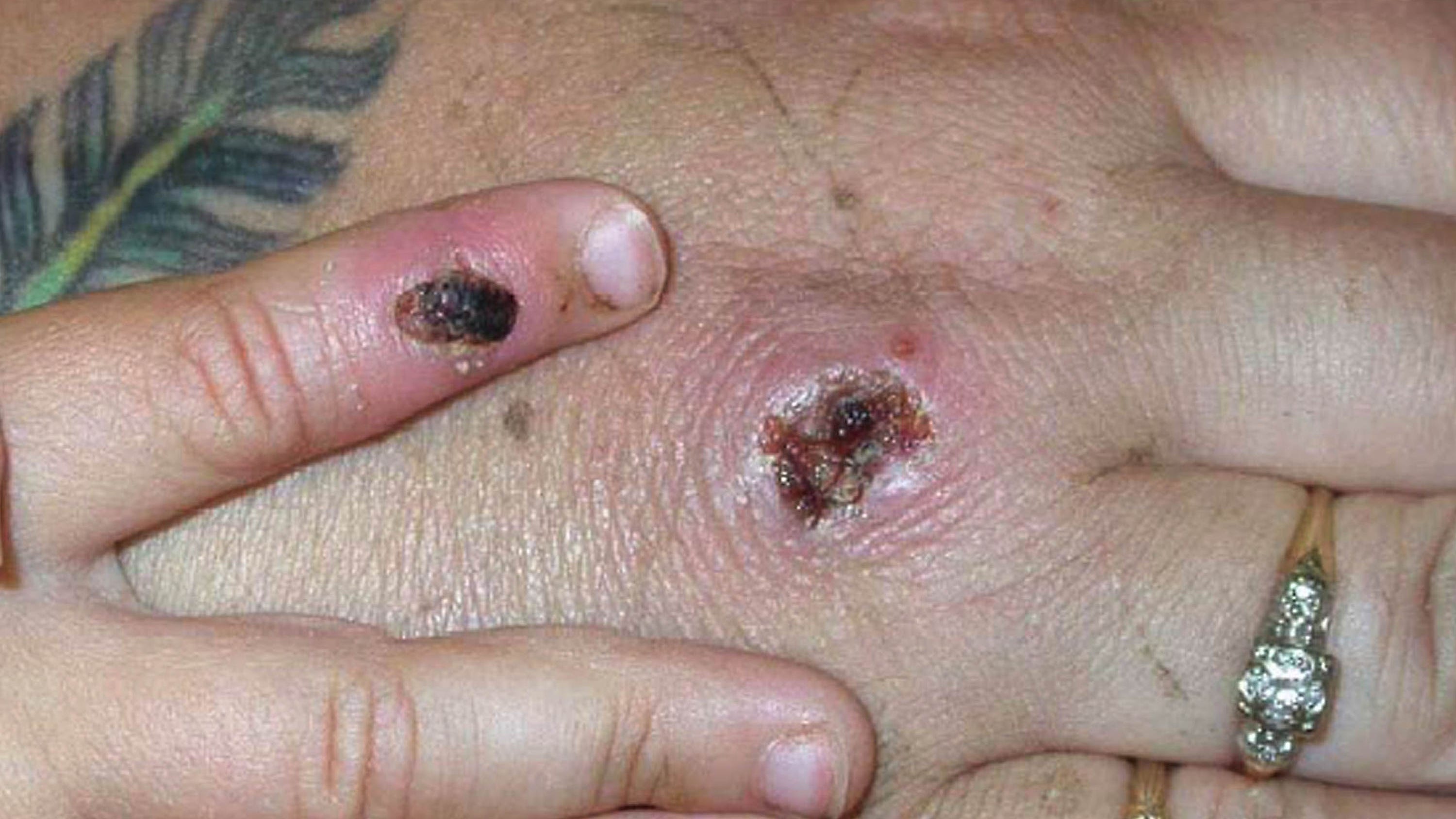 Monkeypox: how concerned should we be?