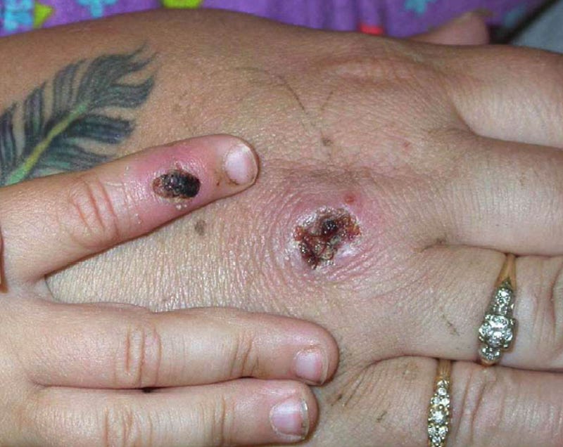 Monkey Pox Lesions
