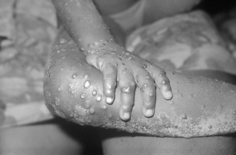 Monkeypox vaccines exist, but they're limited