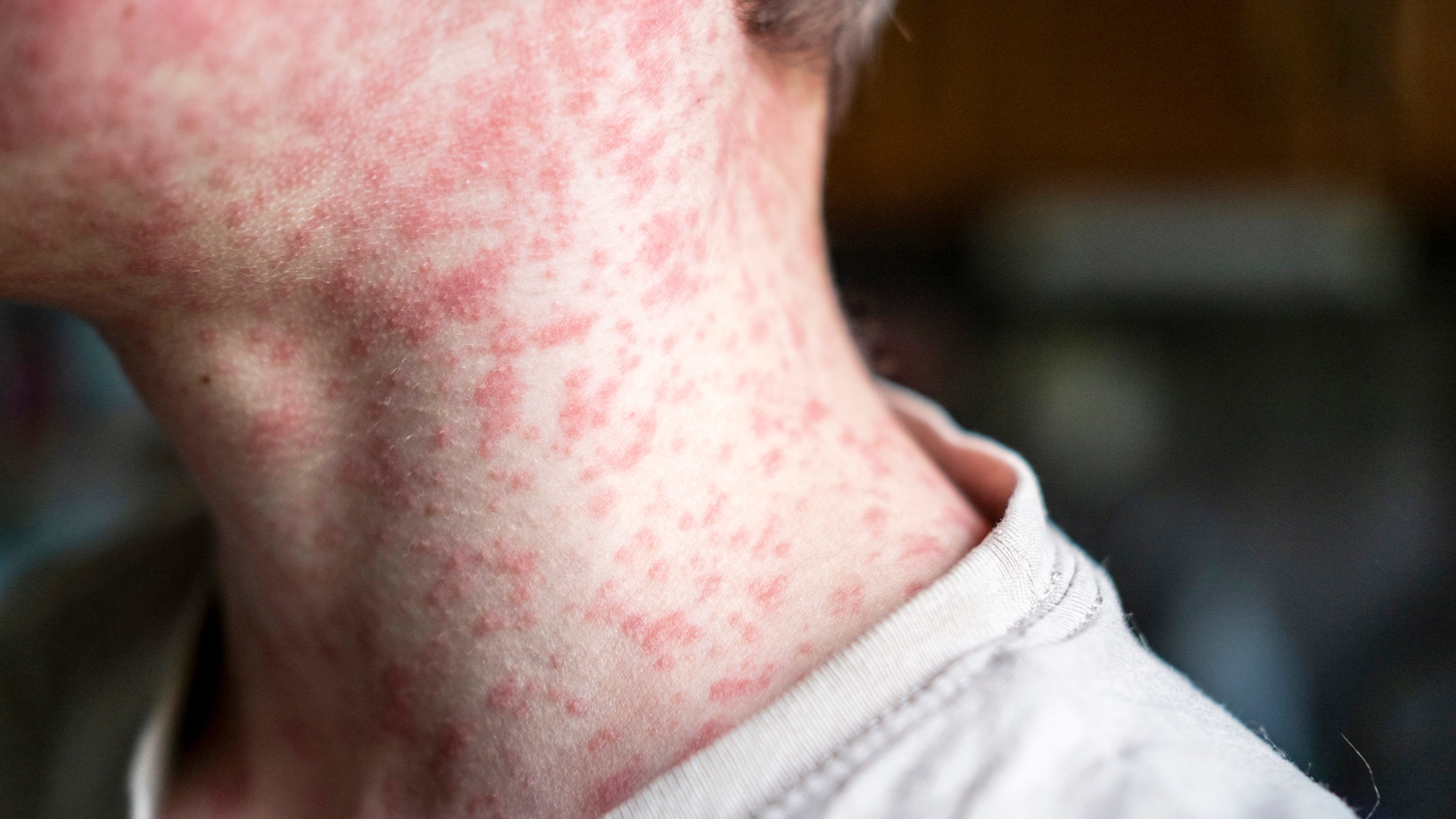 LDH: Second measles case in New Orleans area confirmed