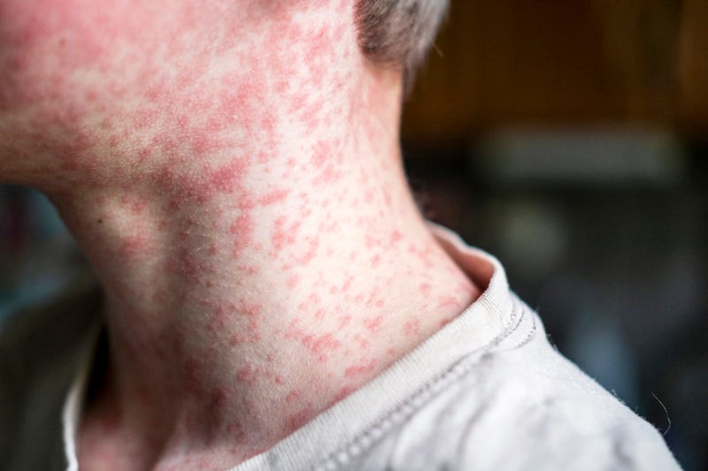 The New Jersey Department of Health confirmed a recent case of measles that could have potentially exposed visitors of two counties.