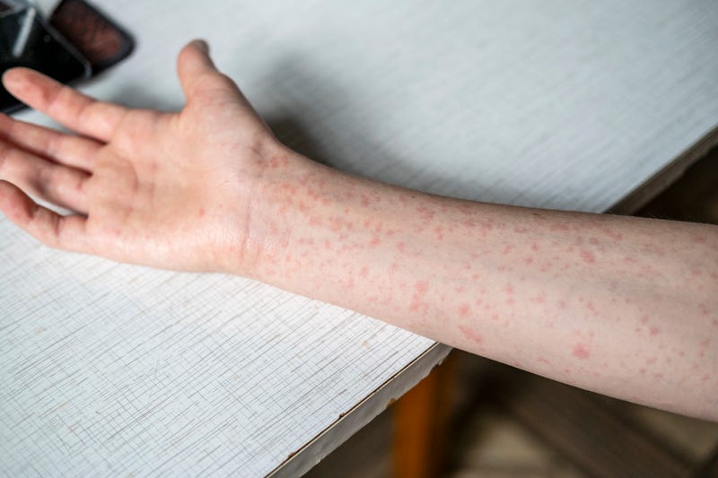 measles