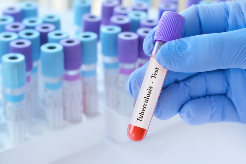 Doctor holding a test blood sample tube with Tuberculosis test