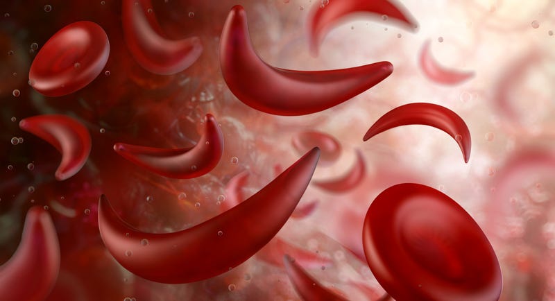 Sickle cell anemia. Deformed red blood cells within the bloodstream. The cells are crescent-shaped, obstructing blood flow and oxygen delivery through small blood vessels. Medical scientific 3D image.