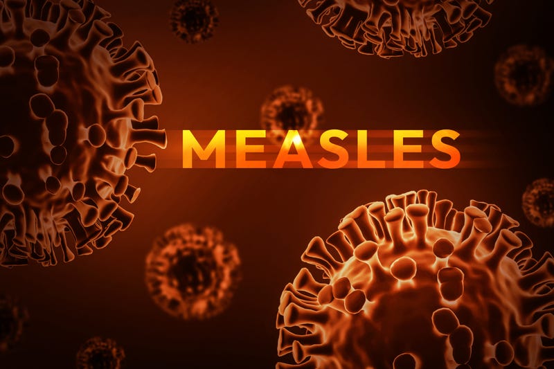 Measles