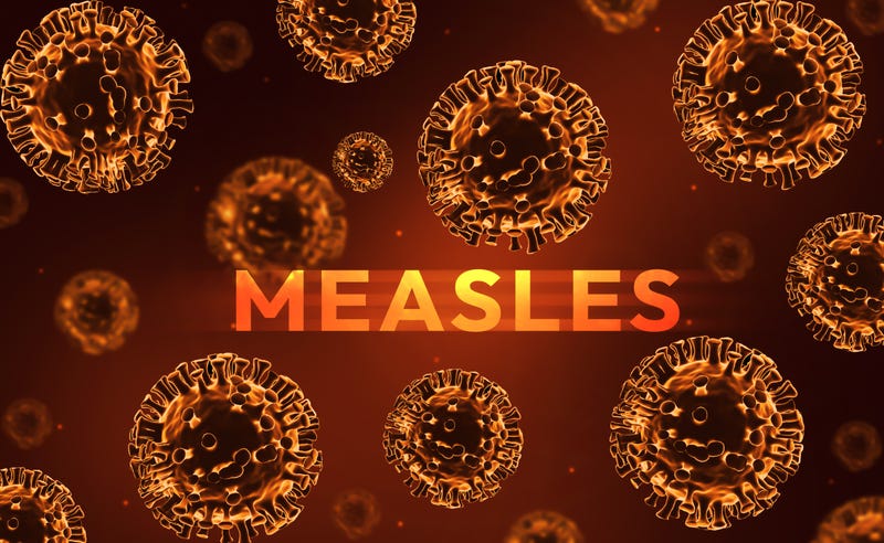 Measles