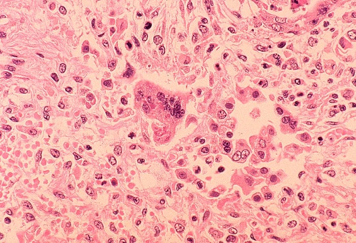measles